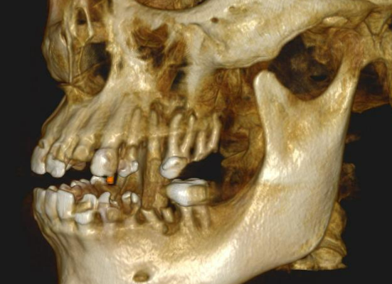 Lateral left view of the 3D virtual model detailing the posterior segment decay before extraction.