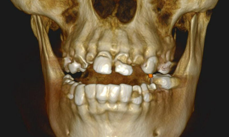 3D virtual model of the patient’s maxilla and mandible showing extensive bone volume loss in the upper jaw.