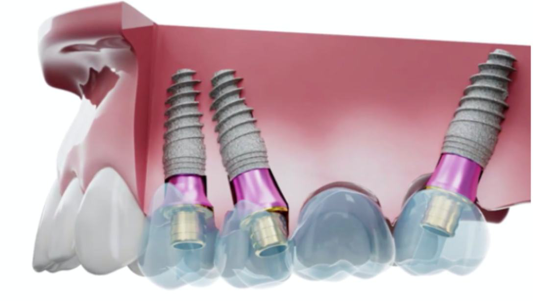 Straight V-Type Multi-Units compensating for the angulation of the implants.