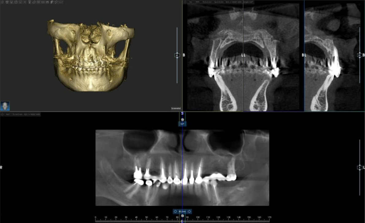 CBCT scan showing 3D reconstruction and coronal views for dental implant treatment planning