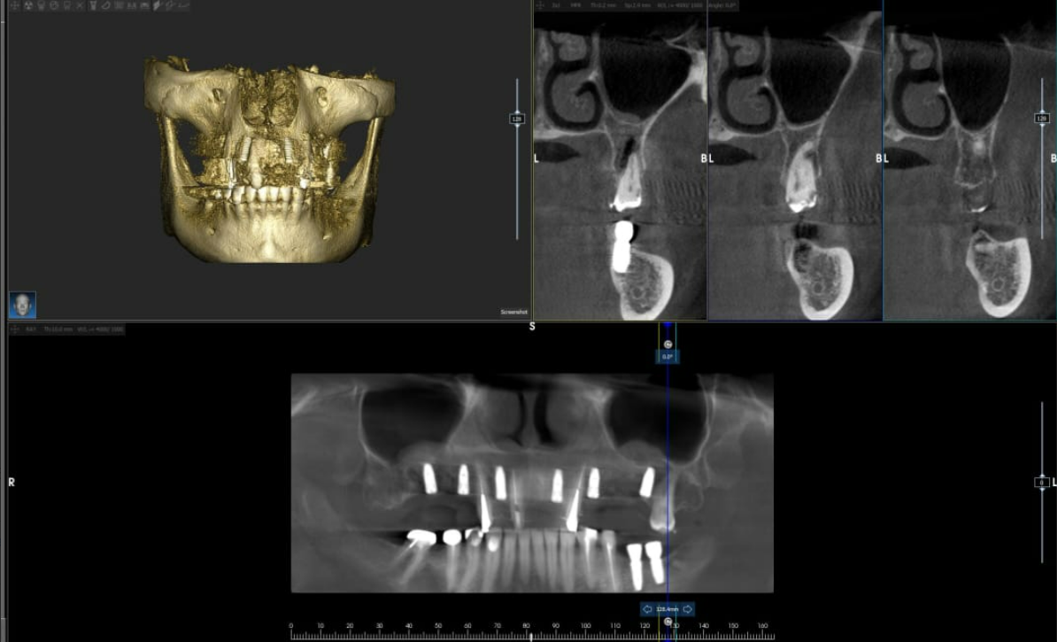 Cone beam CT scan showing dental implants placed in jaw with 3D reconstruction and cross-sectional views