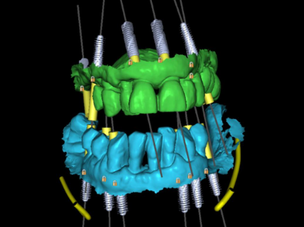 Merged DICOM and STL data forming a single 3D model of the maxilla and mandible.