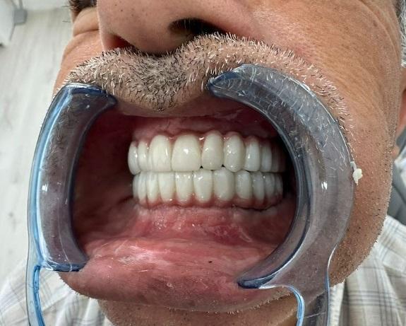 Frontal view of both full-arch prostheses in occlusion with cheek retractors in place.