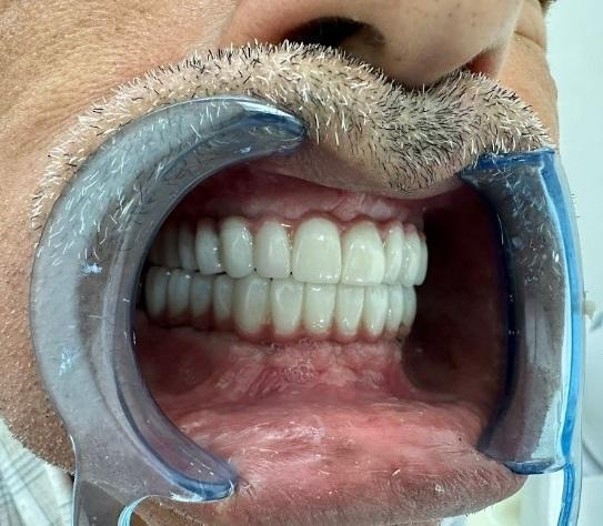 Lateral view of the seated maxillary and mandibular prostheses in occlusion.