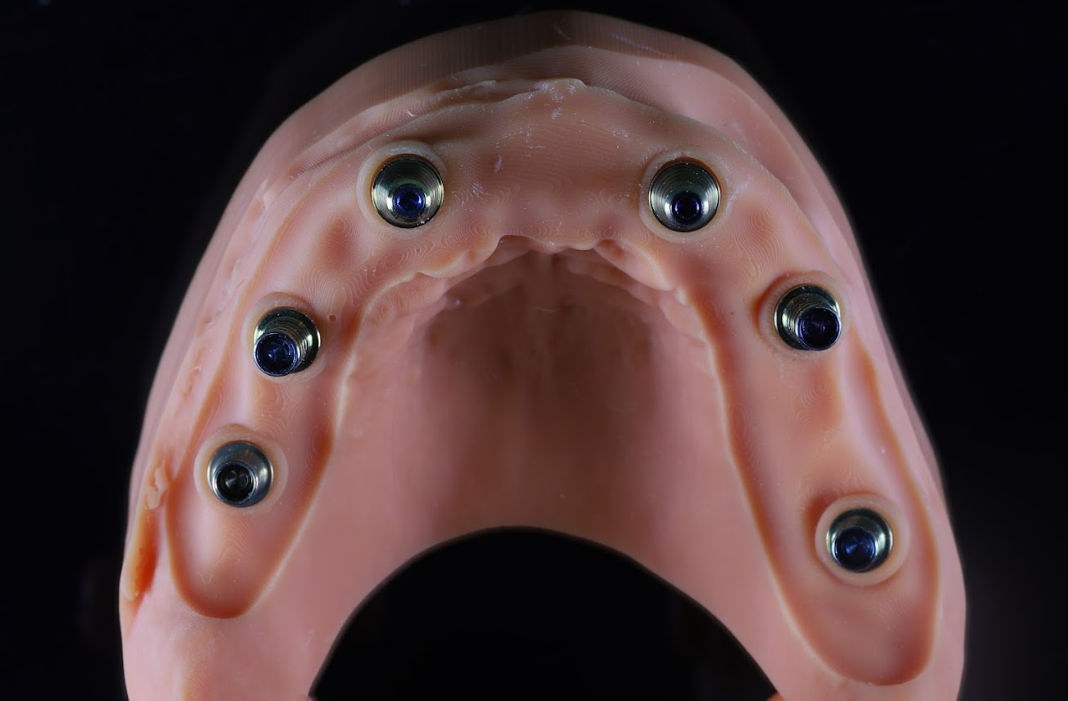 Pink gingival mask on jaw model showing six dental implant abutments with metal attachments