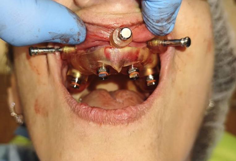 Implant placement through the guide sleeves of the surgical guide in the maxilla.