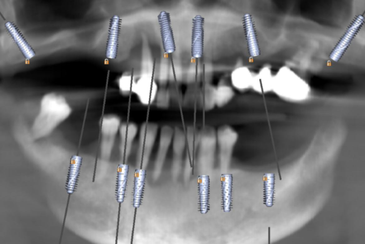 Cross-sectional views of an implant being positioned in specialized planning software.
