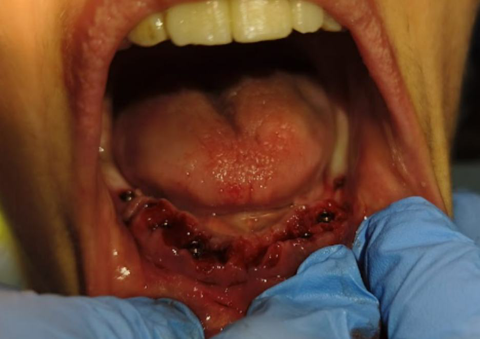 Occlusal view of the placed implants with V-Type Multi-Unit Abutments seated.