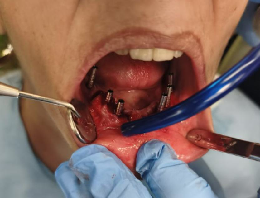 Long cylinders in place for securing the maxillary provisional prosthesis.