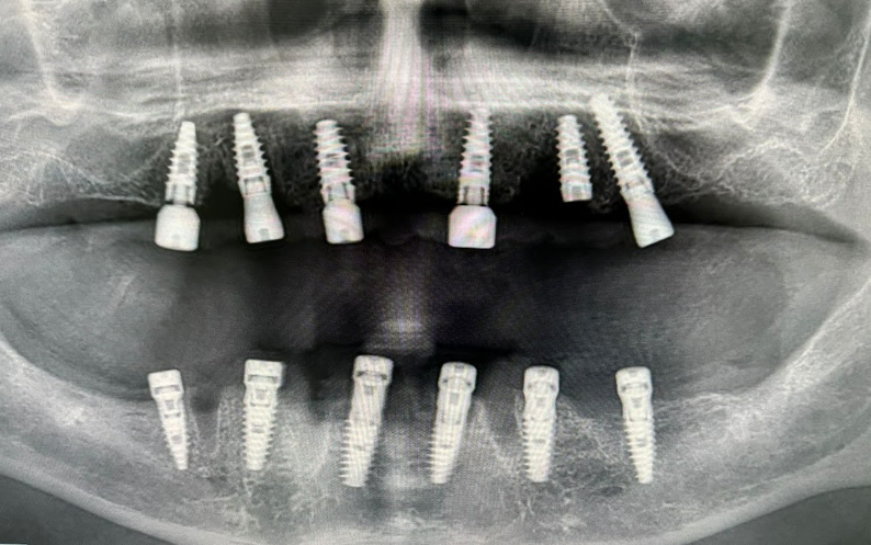 Panoramic radiograph with six implants placed in the maxilla and six in the mandible after the extractions.