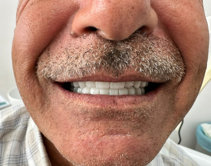 The patient smiling with the completed implant-supported full-arch restorations.