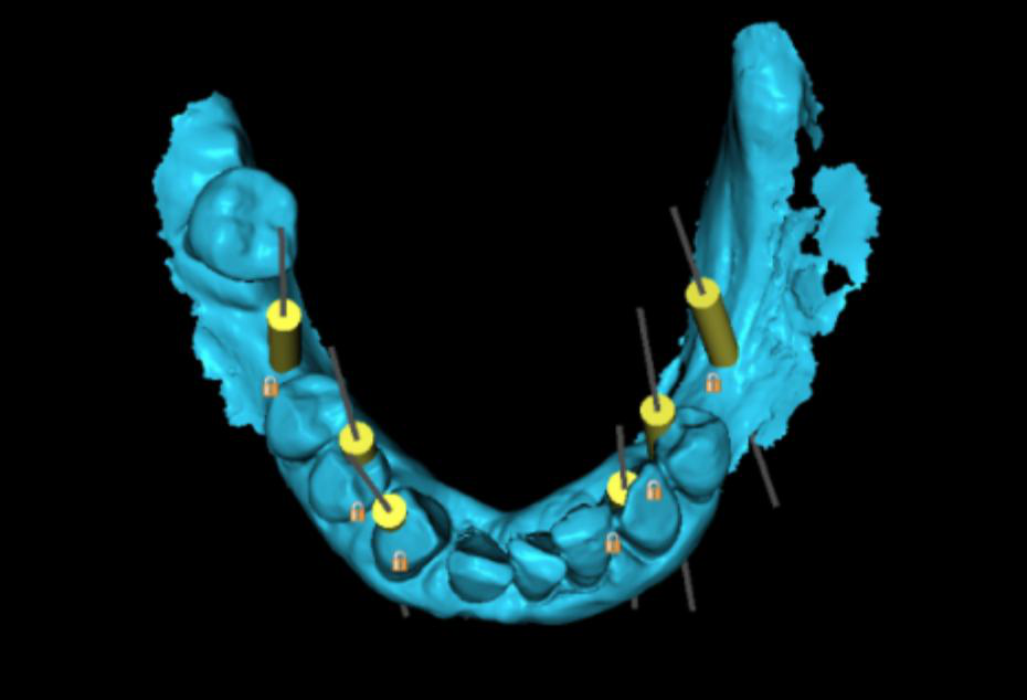 Digital plan of the six implant positions in the mandible.