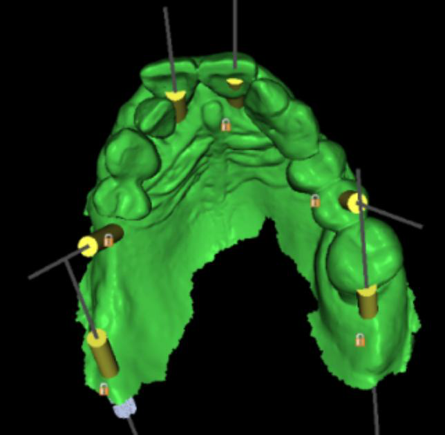 Digital plan of the six implant positions in the maxilla.