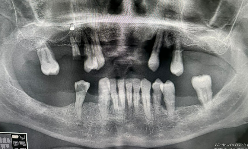Panoramic radiograph showing the few remaining teeth and resorbed alveolar ridges in both jaws.