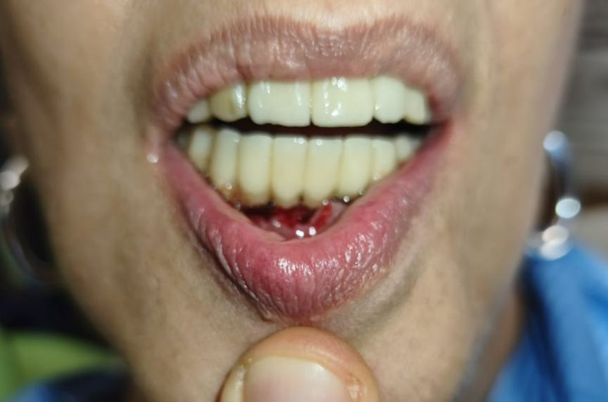 Frontal view of the fixed provisional prosthesis seated in the mouth.