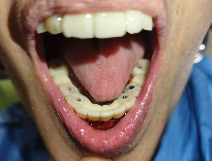 Occlusal view of the screw-retained provisional prosthesis in place.