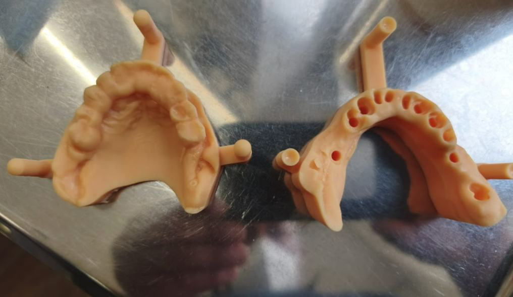 Screw-retained provisional prostheses for both jaws before delivery.