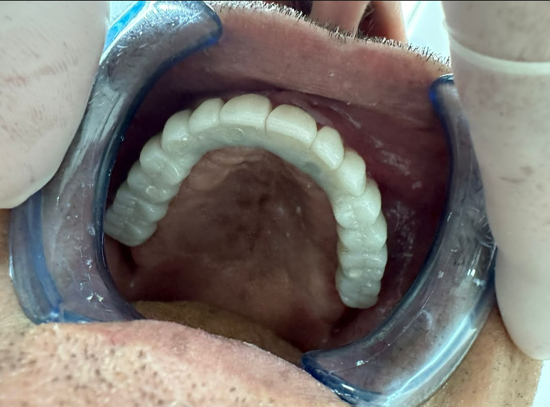 Occlusal view of the maxillary prosthesis with all screw access holes sealed.