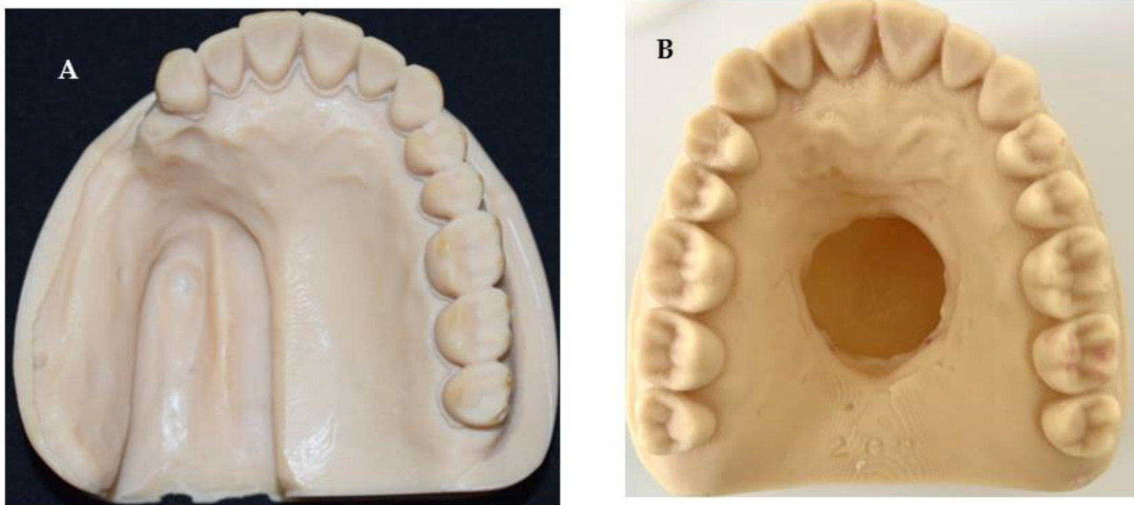Two 3D-printed models of maxillary defects: a unilateral posterior defect and a central palatal defect.
