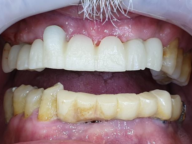 A finished zirconia dioxide upper jaw bridge with a protrusion opposite an irregularly positioned implant