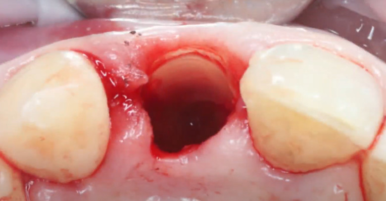 Buccal wall (shield) ready for further manipulations: color and condition of completely healthy tissue YouTube / Dr. Kamil Khabiev / Dental Guru Academy