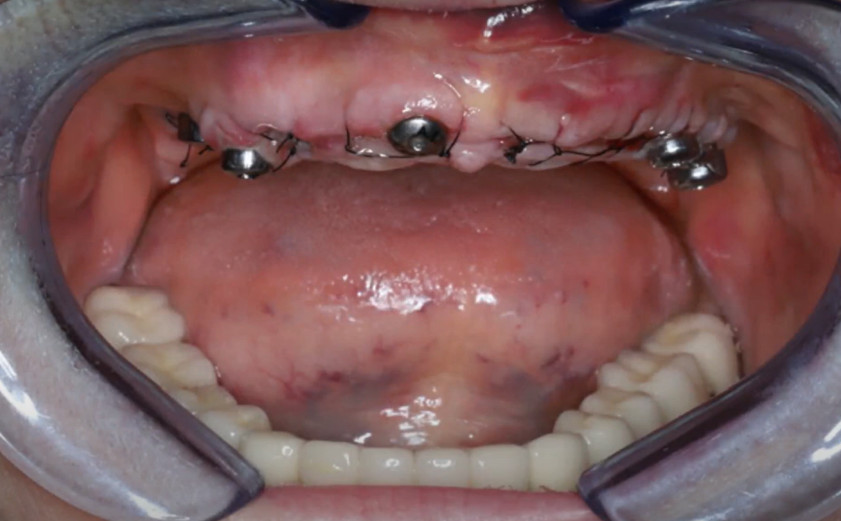 Condition of soft tissue before placement of the temporary prosthesis YouTube / Dr. Kamil Khabiev / Dental Guru Academy