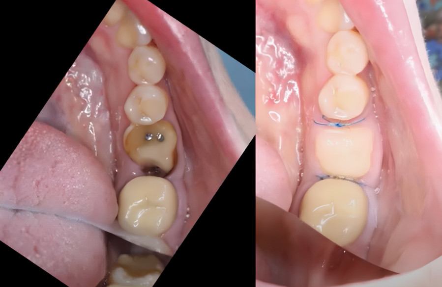 Fabrication of a custom healing cap (left) and the healing outcome three days after placement (right) YouTube / Dr. Kamil Khabiev / Dental Guru Academy
