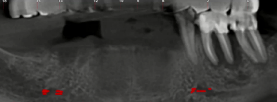 Initial situation - significant loss of teeth in the lower jaw YouTube / Dr. Kamil Khabiev / Dental Guru Academy