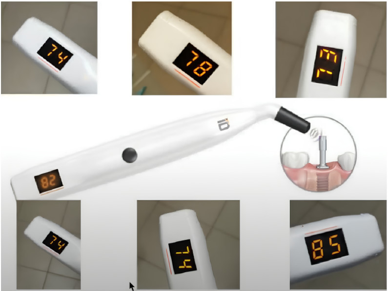 Instrument readings to determine the primary stability of placed implants: all implants are placed with very good indicators, which allow immediate loading of the implants YouTube / Dr. Kamil Khabiev / Dental Guru Academy