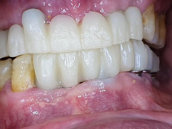 Lower jaw bridge ready for placement (top); upper and lower bridges in the patient's mouth (bottom)