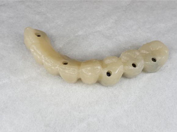 Lower jaw bridge ready for placement (top); upper and lower bridges in the patient's mouth (bottom)