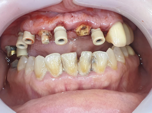 Preparing for scanning with an intraoral scanner