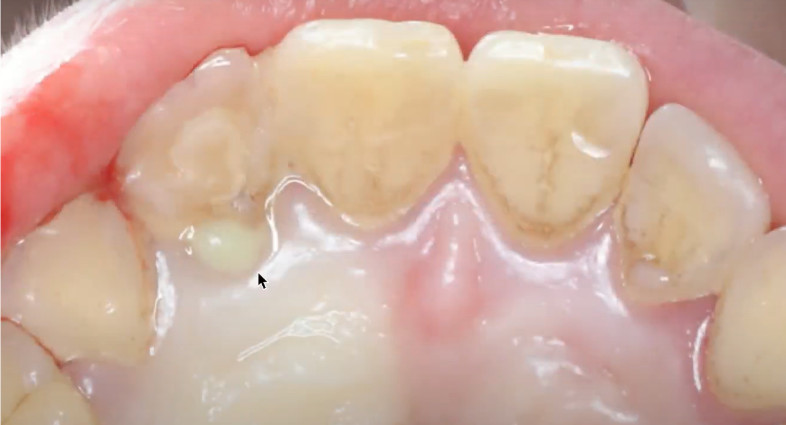 Pus discharge from the palatal side of the problem tooth (12) YouTube / Dr. Kamil Khabiev / Dental Guru Academy