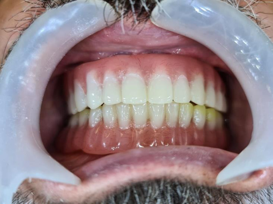 Removable denture with bar retention