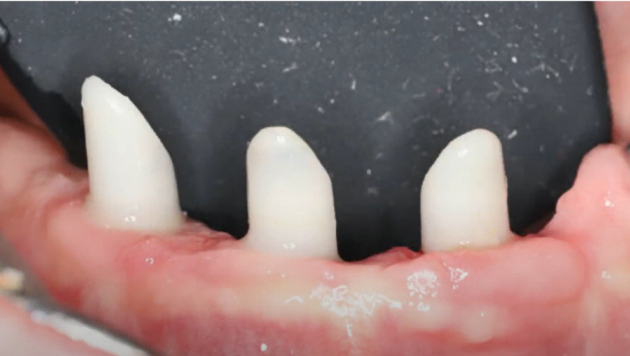 Soft tissue condition three months after placement of a temporary prosthesis YouTube / Dr. Kamil Khabiev / Dental Guru Academy