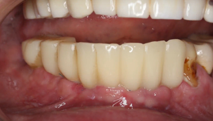 Temporary prosthesis in the patient’s mouth