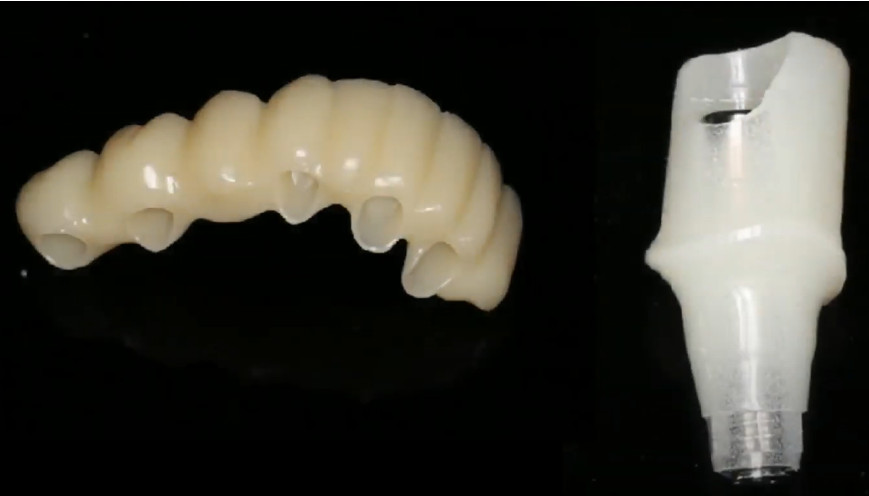 The temporary abutment and restoration are made and are kept by the doctor before the operation YouTube / Dr. Kamil Khabiev / Dental Guru Academy
