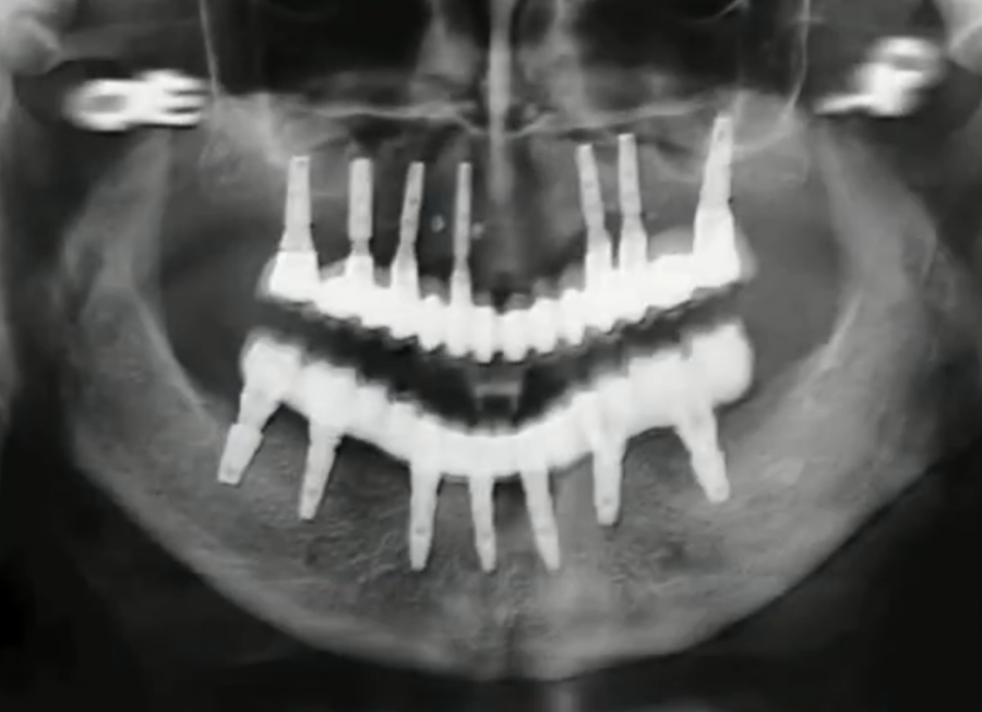 X-ray of both jaws with implants and prostheses YouTube / Dr. Kamil Khabiev / Dental Guru Academy