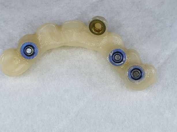 Zirconium dioxide upper jaw bridge