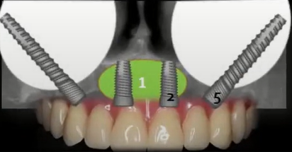 Advanced atrophy requiring a hybrid approach