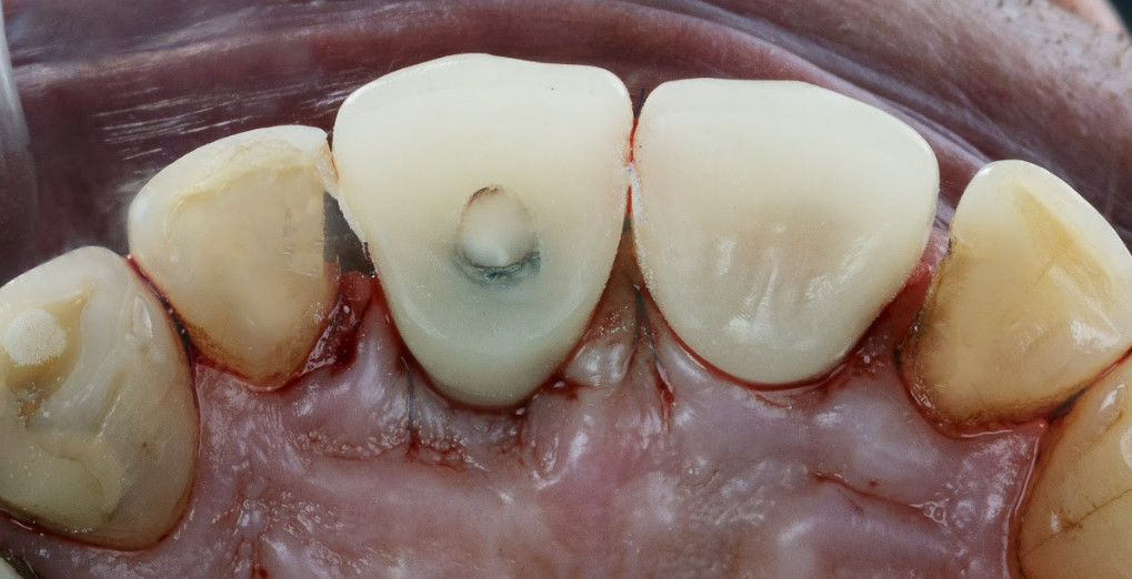 Screw exit to the inside of the crown