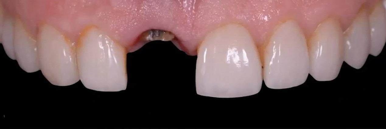 Frontal intraoral view showing the empty anterior site after loss of the crown and post.