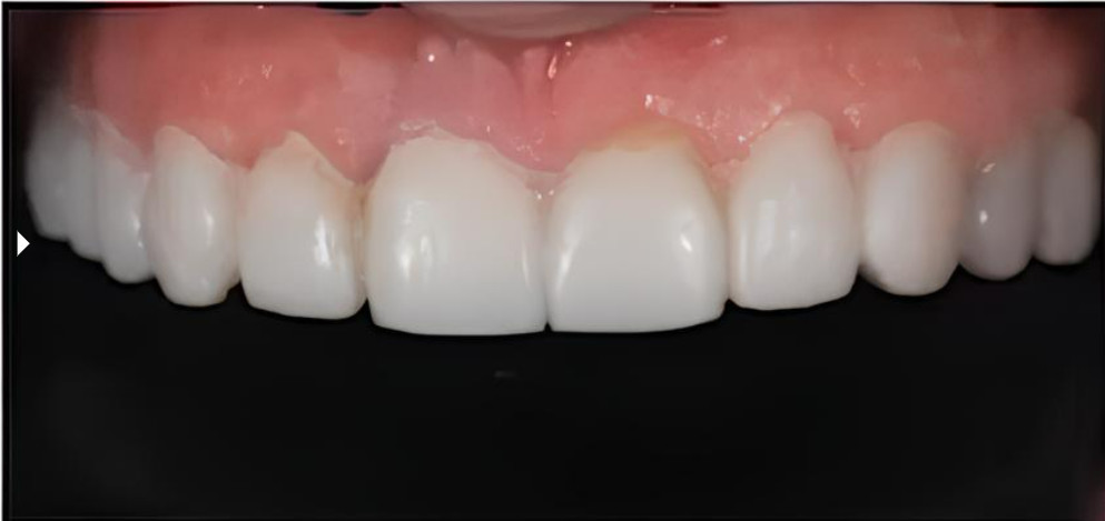 Anterior mock-up with the aesthetic pre-evaluative temporary used to test shape and function before tooth preparation.