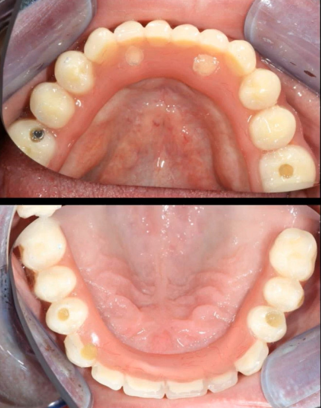 Before and after views of upper dental arch showing completed implant restoration