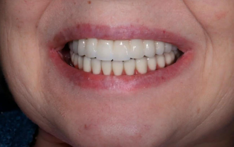 The final result: both arches exhibit excellent aesthetics, and chewing function is fully restored YouTube / Dr. Kamil Khabiev / Dental Guru Academy