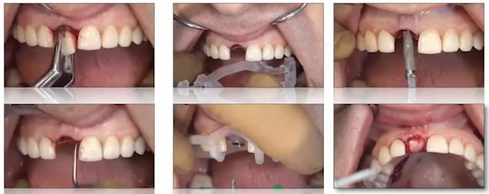 Composite clinical slide showing extraction, socket debridement, guided implant placement, and graft closure steps.