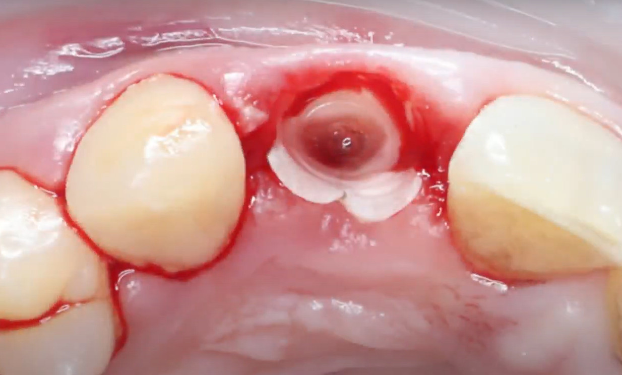 Prepared buccal wall and ground palatal wall before the stage of its removal