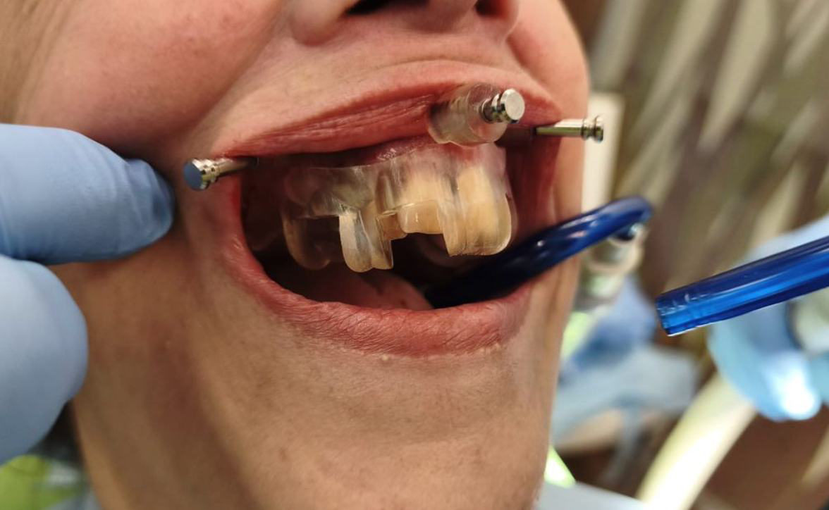 Verifying the seating of the surgical guide before extraction of the maxillary teeth.