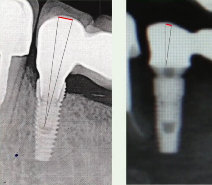 Comparison of framework deviation with screw retention directly to an implant versus to a multi-unit abutment (MUA): Using MUAs significantly lowers the likelihood of complications