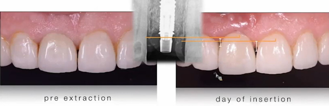 Side-by-side comparison of gingival contours before implant placement and on delivery day of the new screw-retained restoration.